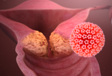 سرطان های ناشی از HPV