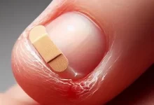 تصویر یک ناخن اسیب دیده نیازمند به تقویت ناخن