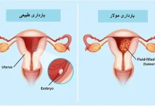 تصویری از حاملگی مولار و حاملگی طبیعی