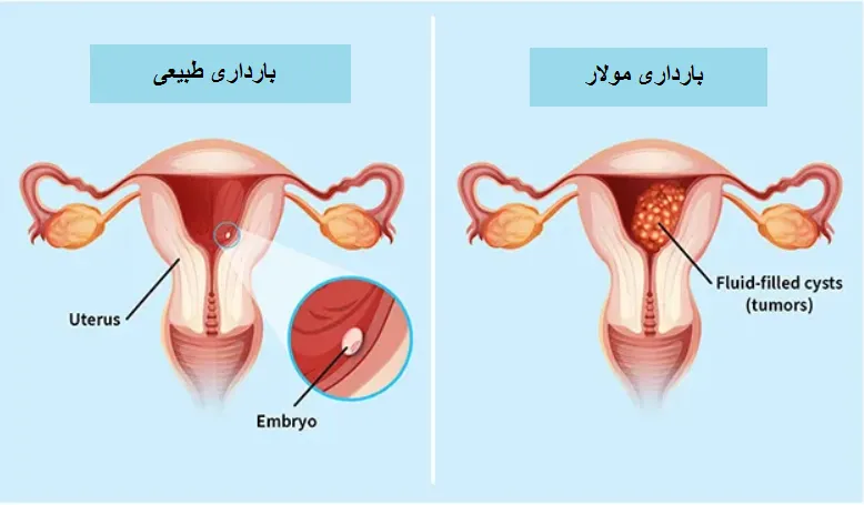 تصویری از حاملگی مولار و حاملگی طبیعی