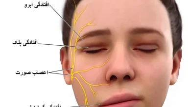 تصویر صورت مبتلا به بیماری فلج بل که دچار افتادگی در یکطرف صورت شده