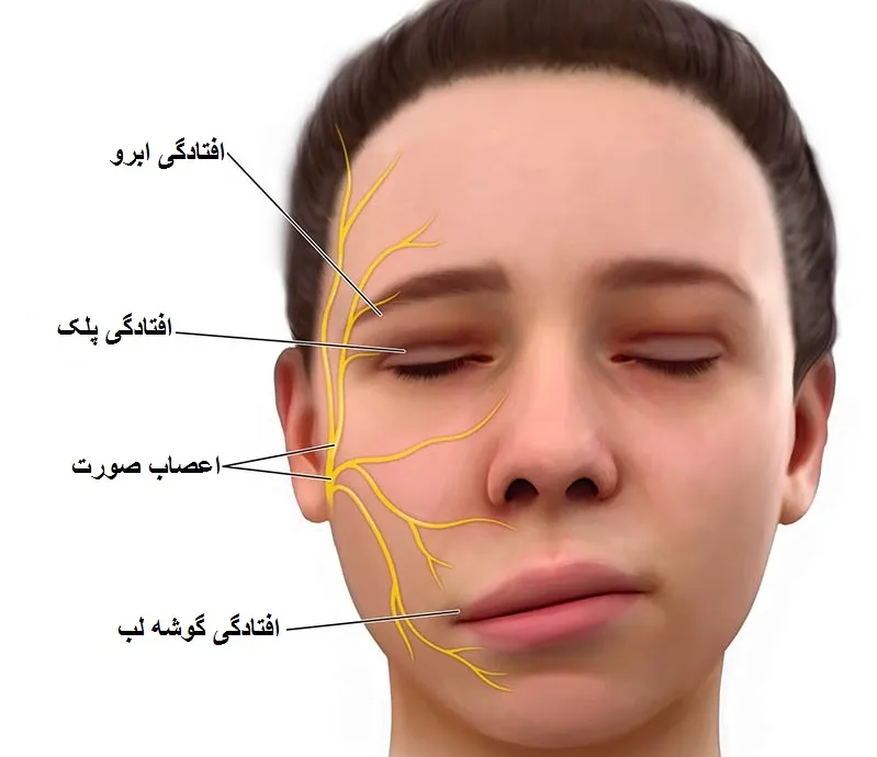 تصویر صورت مبتلا به بیماری فلج بل که دچار افتادگی در یکطرف صورت شده