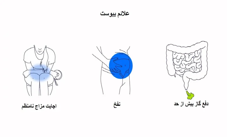 علائم یبوست به صورت تصویری
