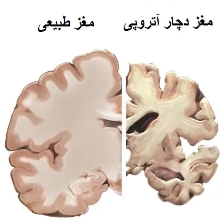 تصویر مغز طبیعی در کنار مغزی که دچار آتروفی مغزی شده است