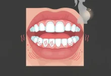 التهاب لثه بارداری- لثه های ملتهب