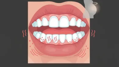 التهاب لثه بارداری- لثه های ملتهب