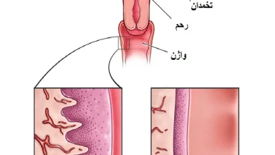 مقایسه پوشش دیواره واژن معمولی و واژنی که دچار آتروفی شده است