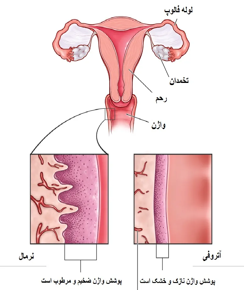مقایسه پوشش دیواره واژن معمولی و واژنی که دچار آتروفی شده است