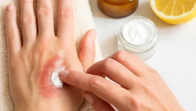 فردی در حال استفاده از درمان های خانگی برای سوختگی دستش